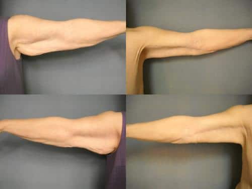 Arm Lift Case #351 Combined Image
