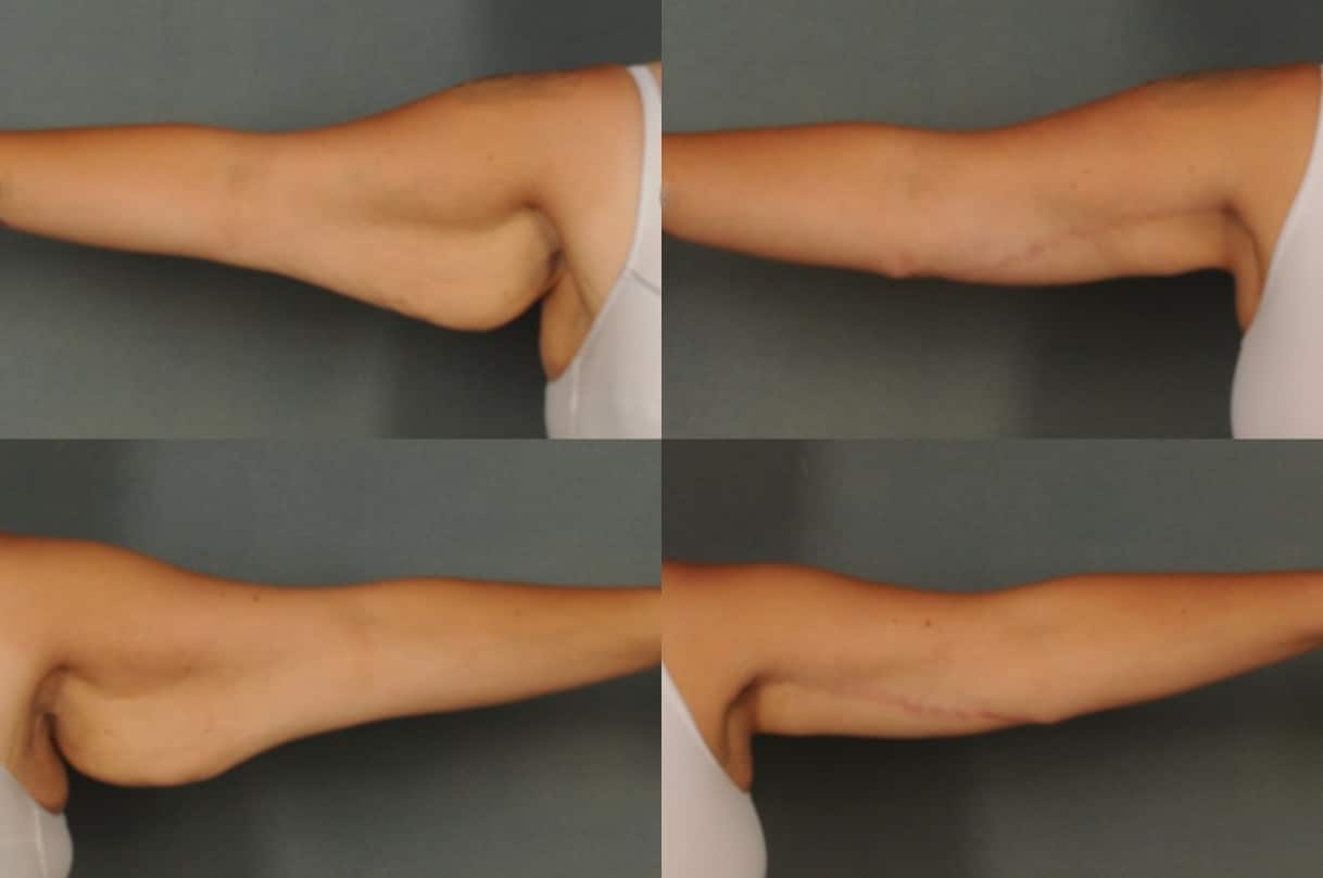 Arm Lift Case# 807 Combined Image
