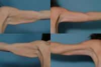 Arm Lift Case #811 Combined Image