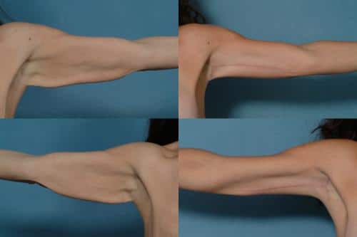 Arm Lift Case #811 Combined Image