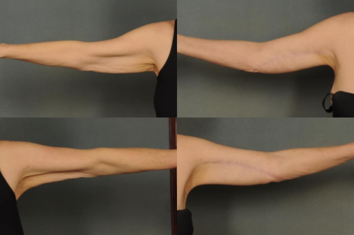 Arm Lift Case # 816 Combined Image