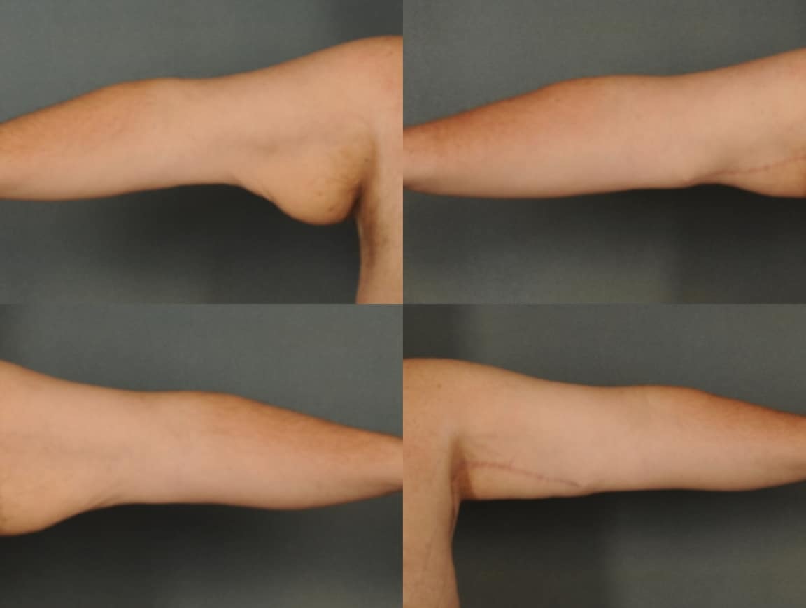 Arm Lift Case # 830 Combined Image