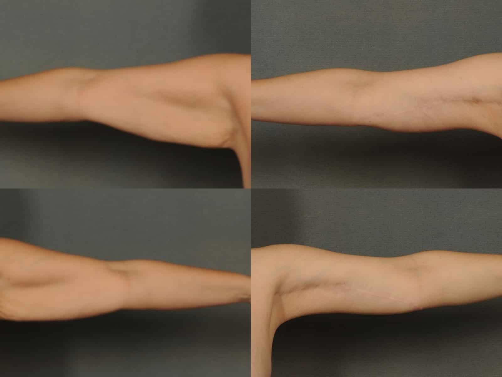 Arm Lift Case# 842 Combined Image