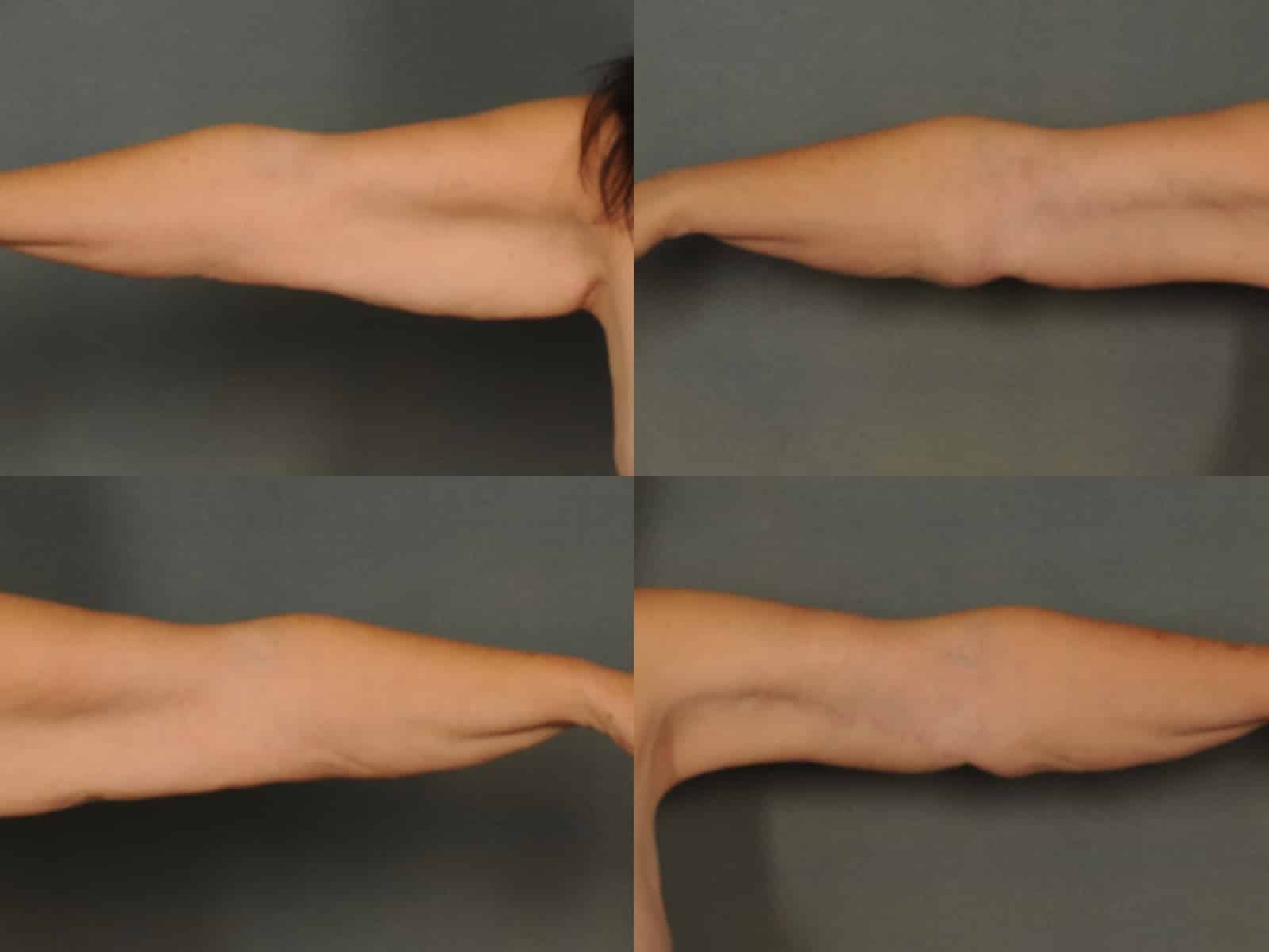 Arm Lift Case# 848 Combined Image