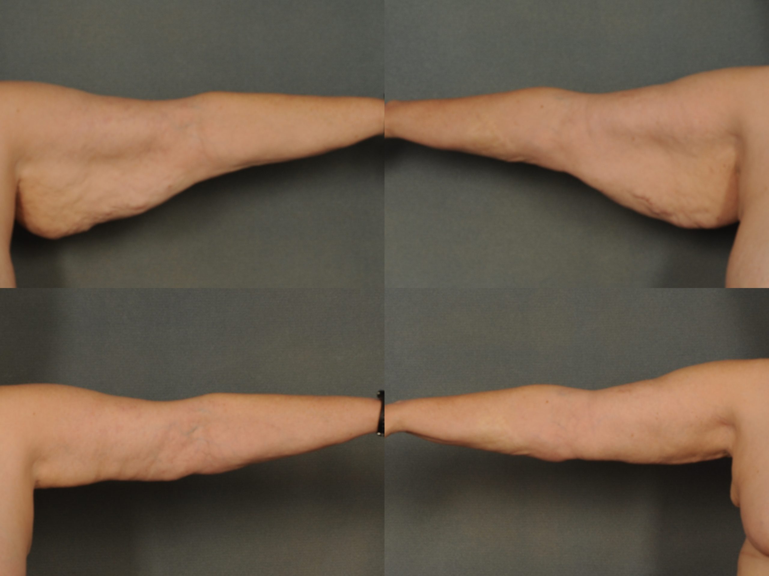 Arm Lift Case# 853 Combined Image