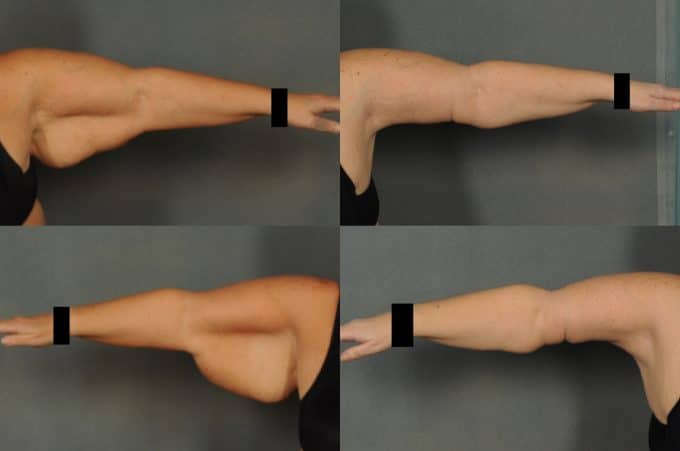Arm Lift Case# 861 Combined Image
