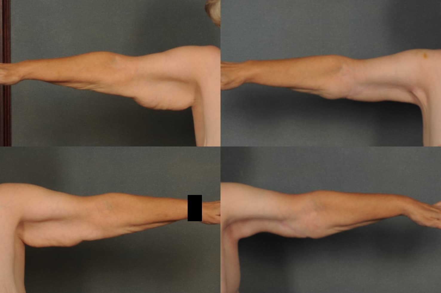 Arm Lift Case# 867 Combined Image