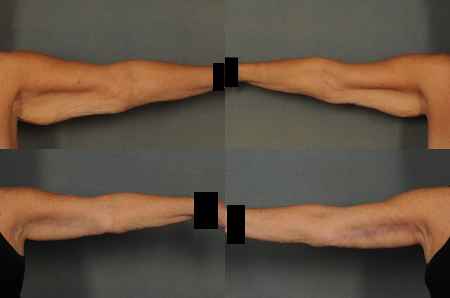 Arm Lift Case# 872 Combined Image