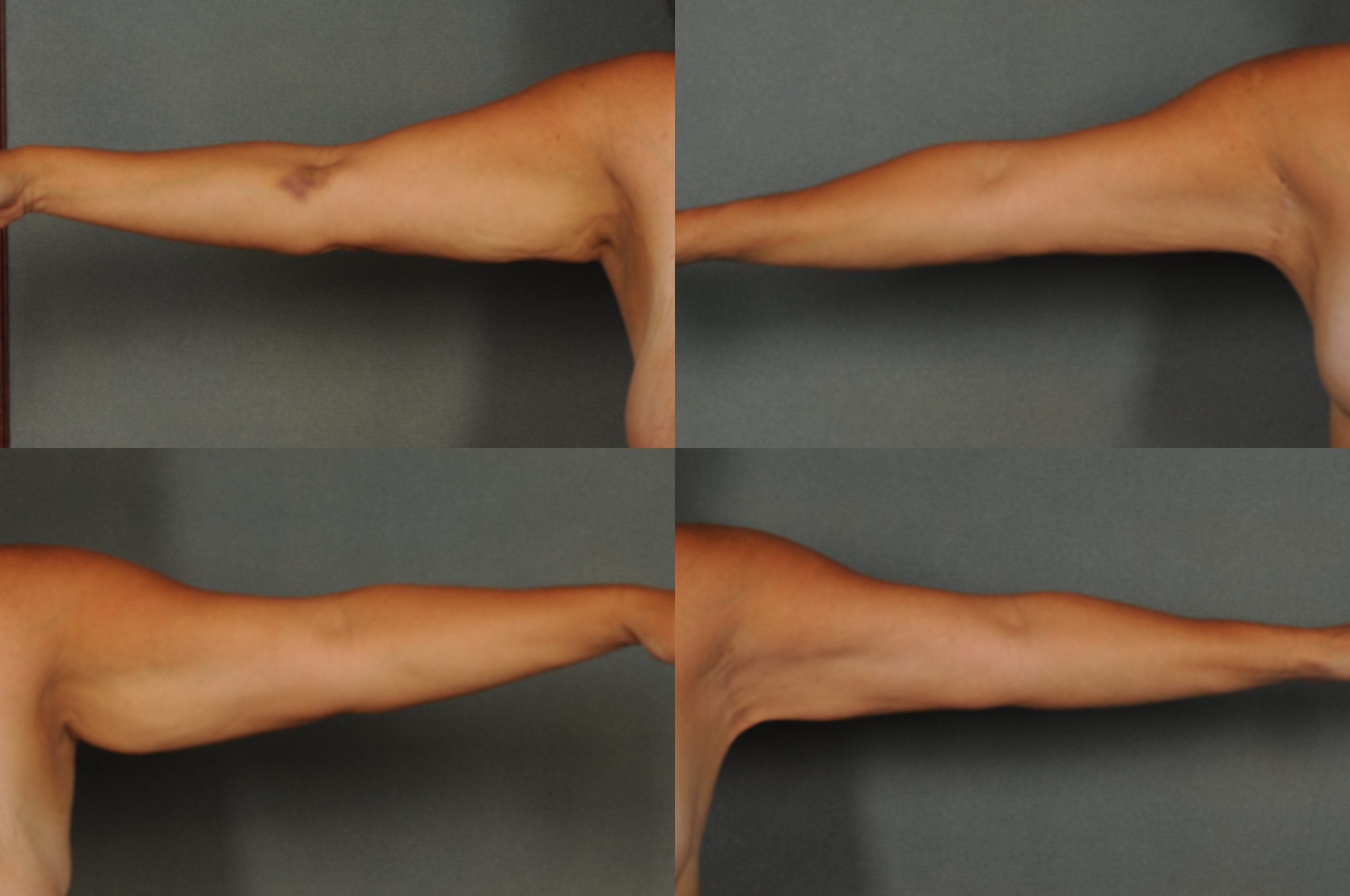 Arm Lift Case# 875 Combined Image
