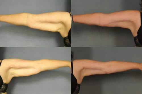 Arm Lift Case #881 Combined Image