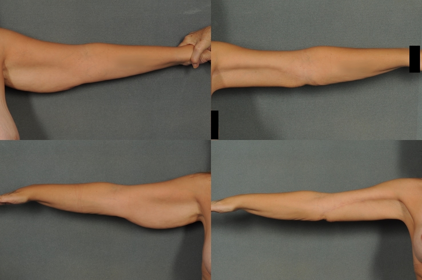 Arm Lift Case# 893 Combined Image