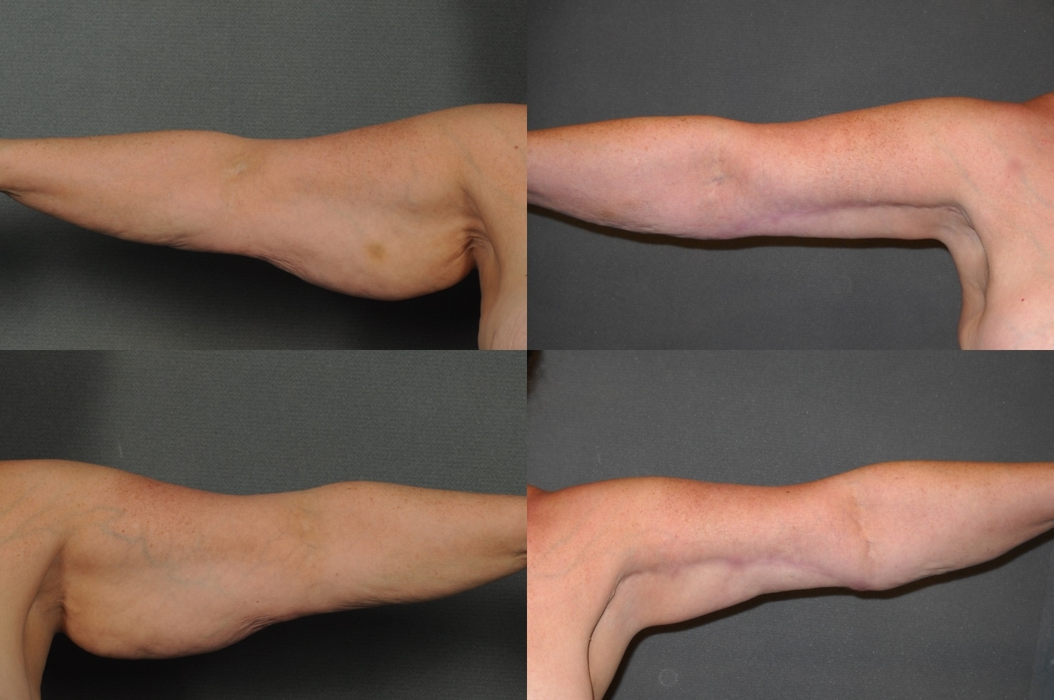 Arm Lift Case# 902 Combined Image
