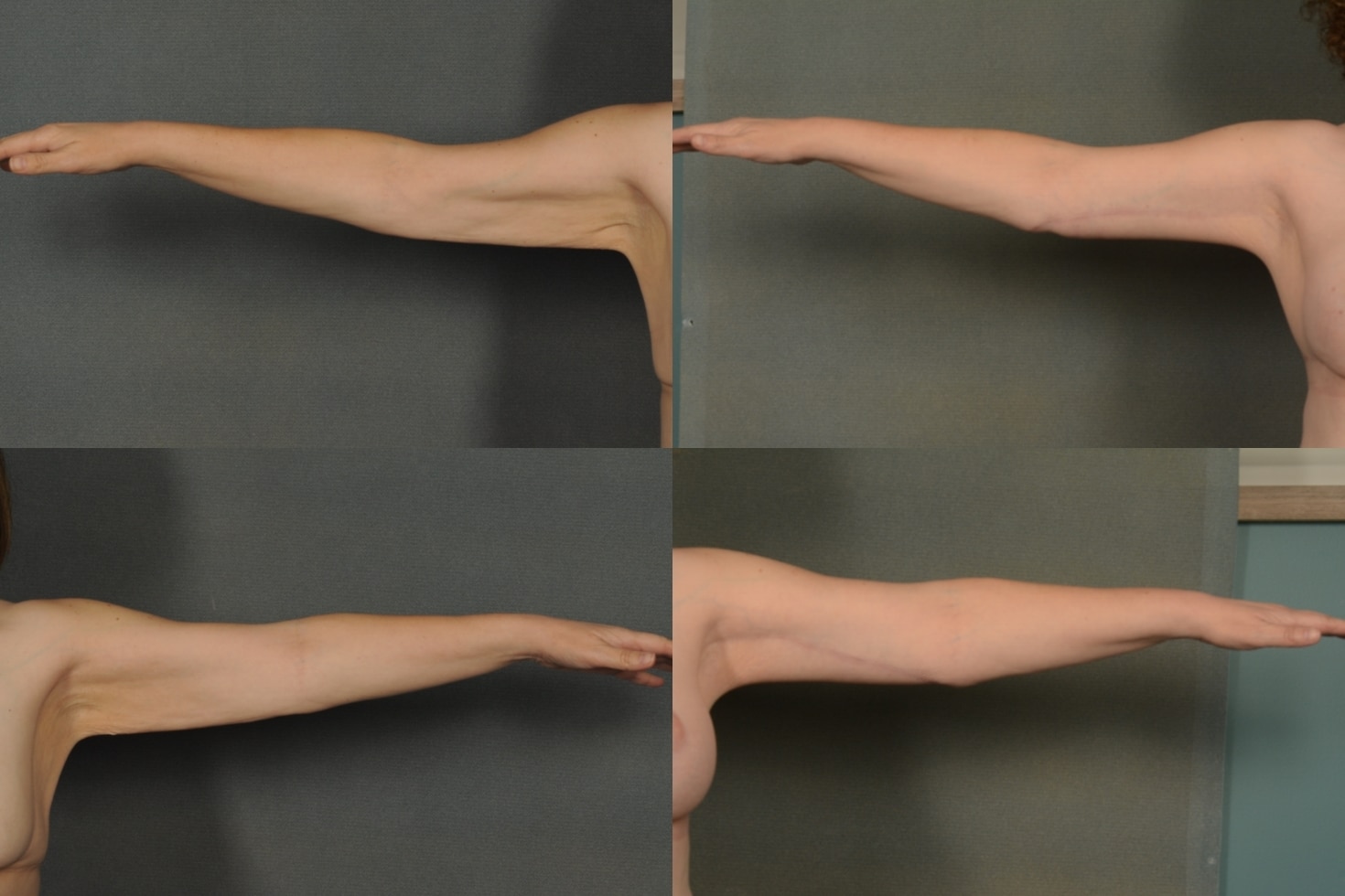 Arm Lift Case# 915 Combined Image