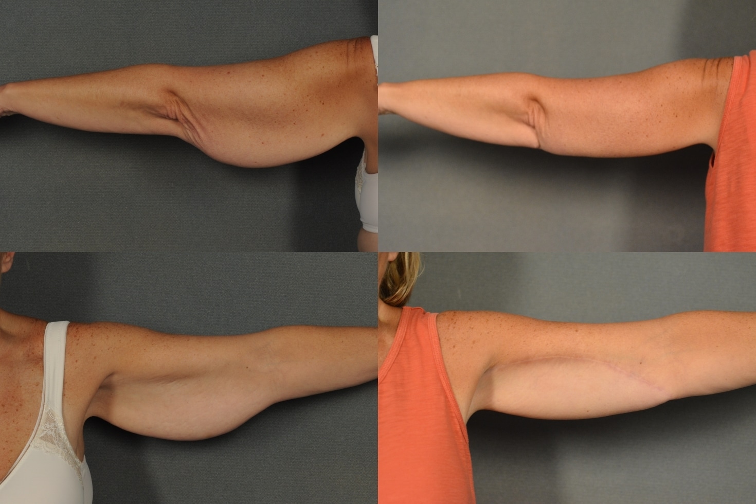 Arm Lift Case 916 Combined Image