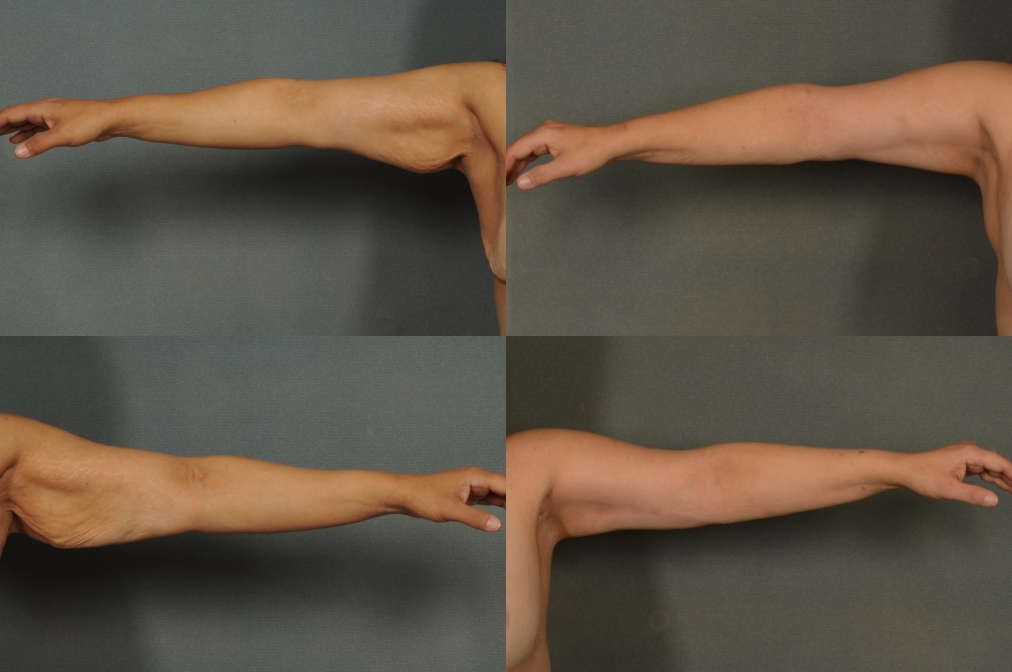 Arm Lift Case# 941 Combined Image