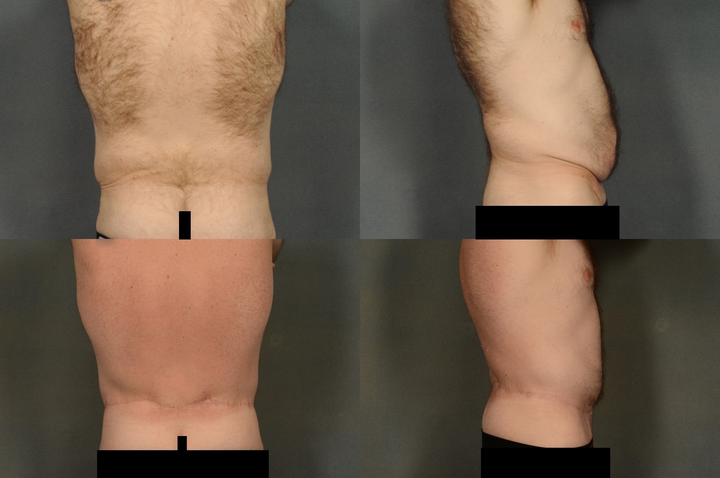 Back Lift Case# 930 Combined Image