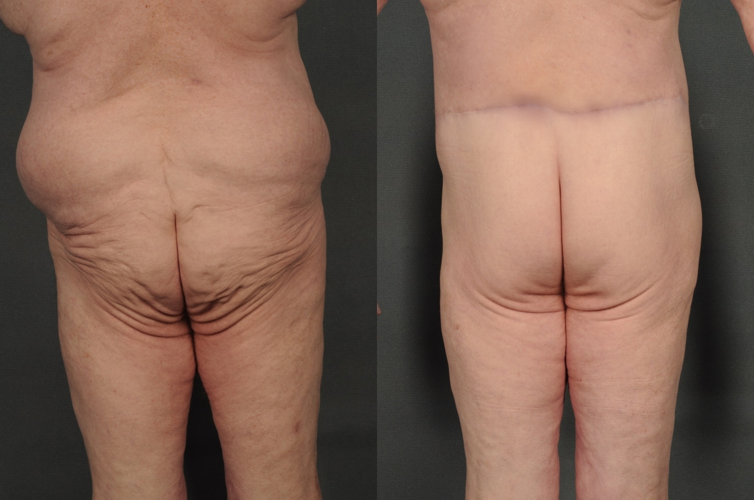 Back Lift Case# 937 Combined Image