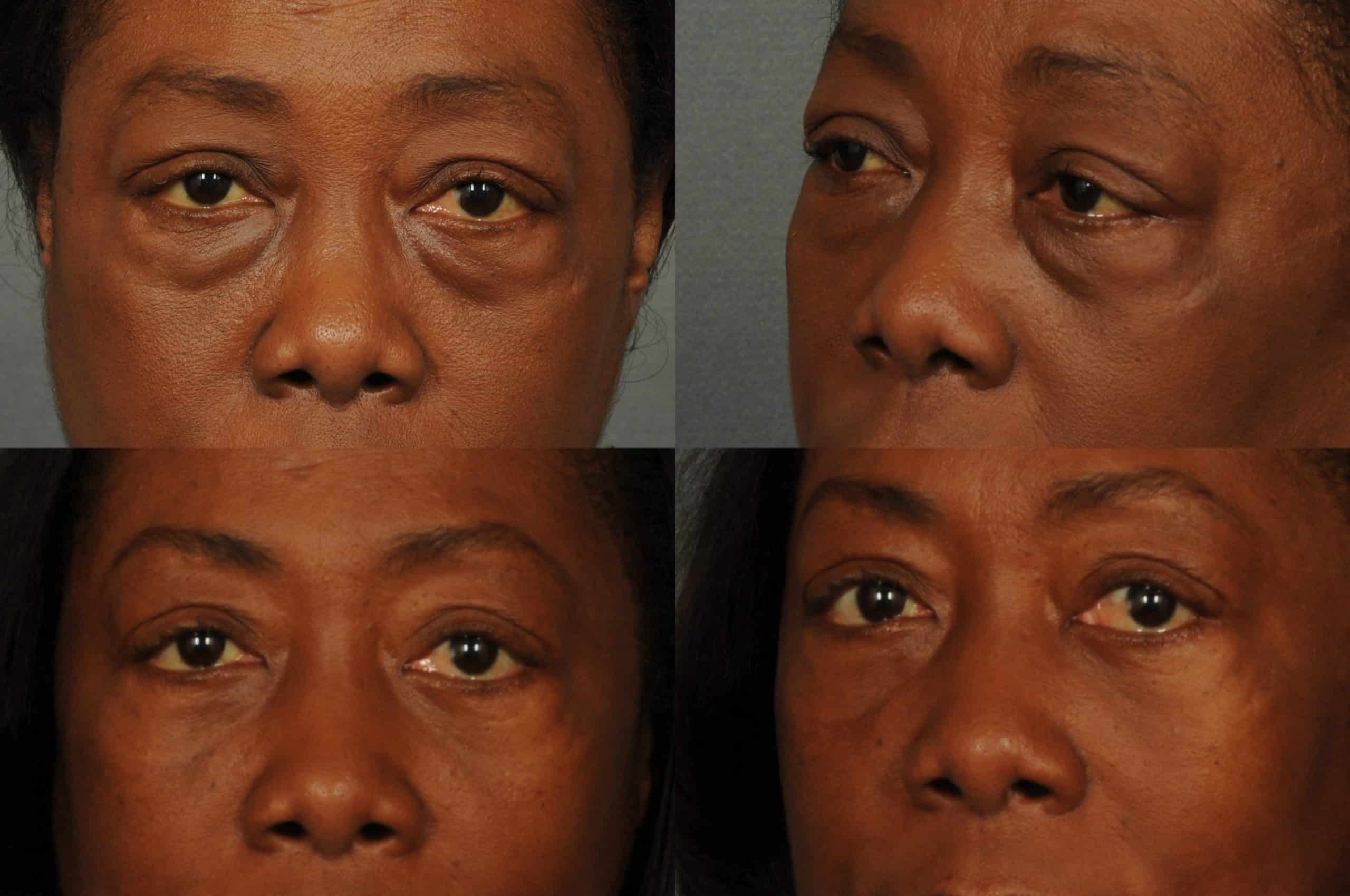 Blepharoplasty Case# 786 Combined Image
