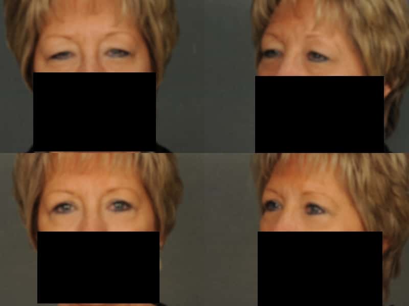 Blepharoplasty Case# 821 Combined Image