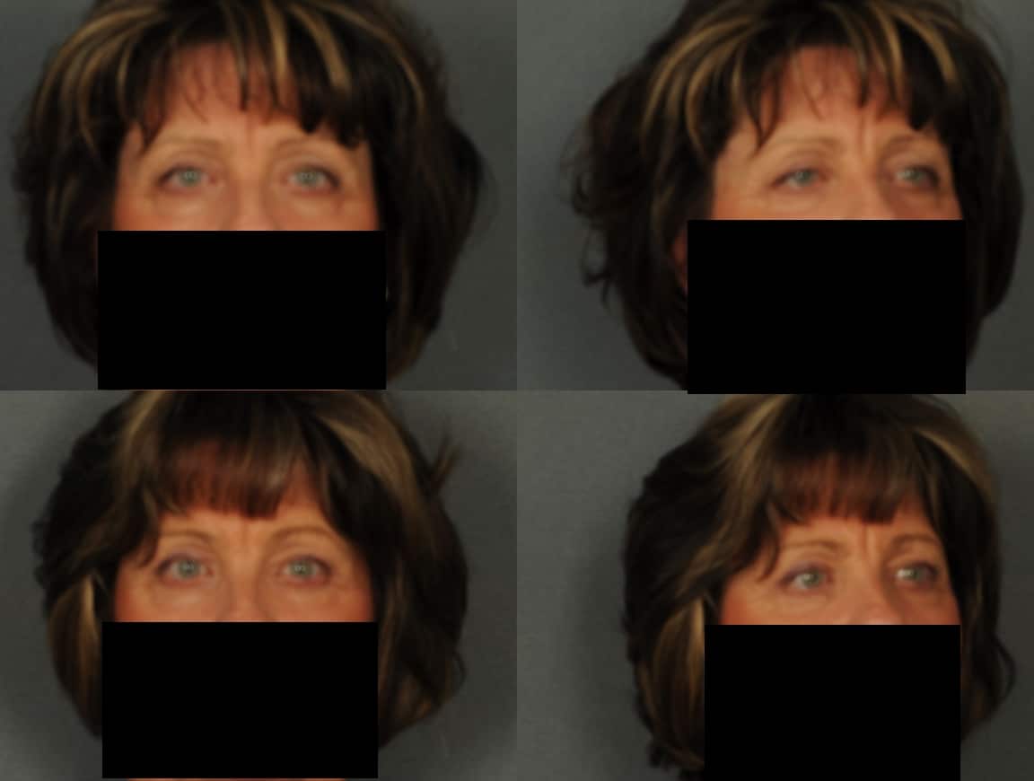 Blepharoplasty Case# 829 Combined Image