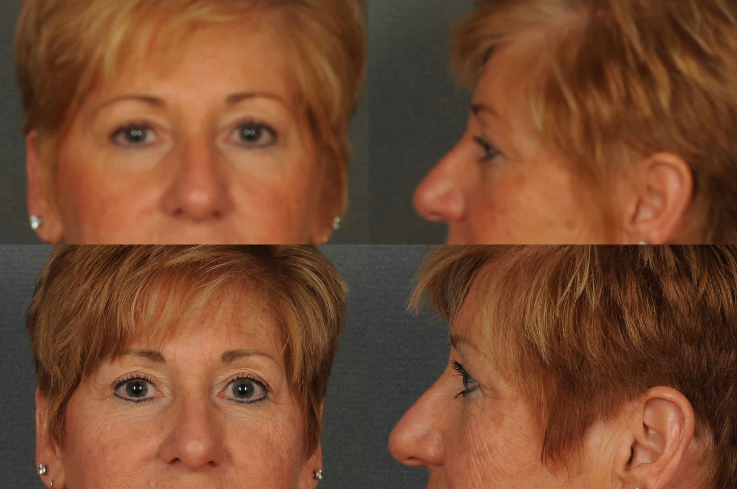 Blepharoplasty Case# 873 Combined Image