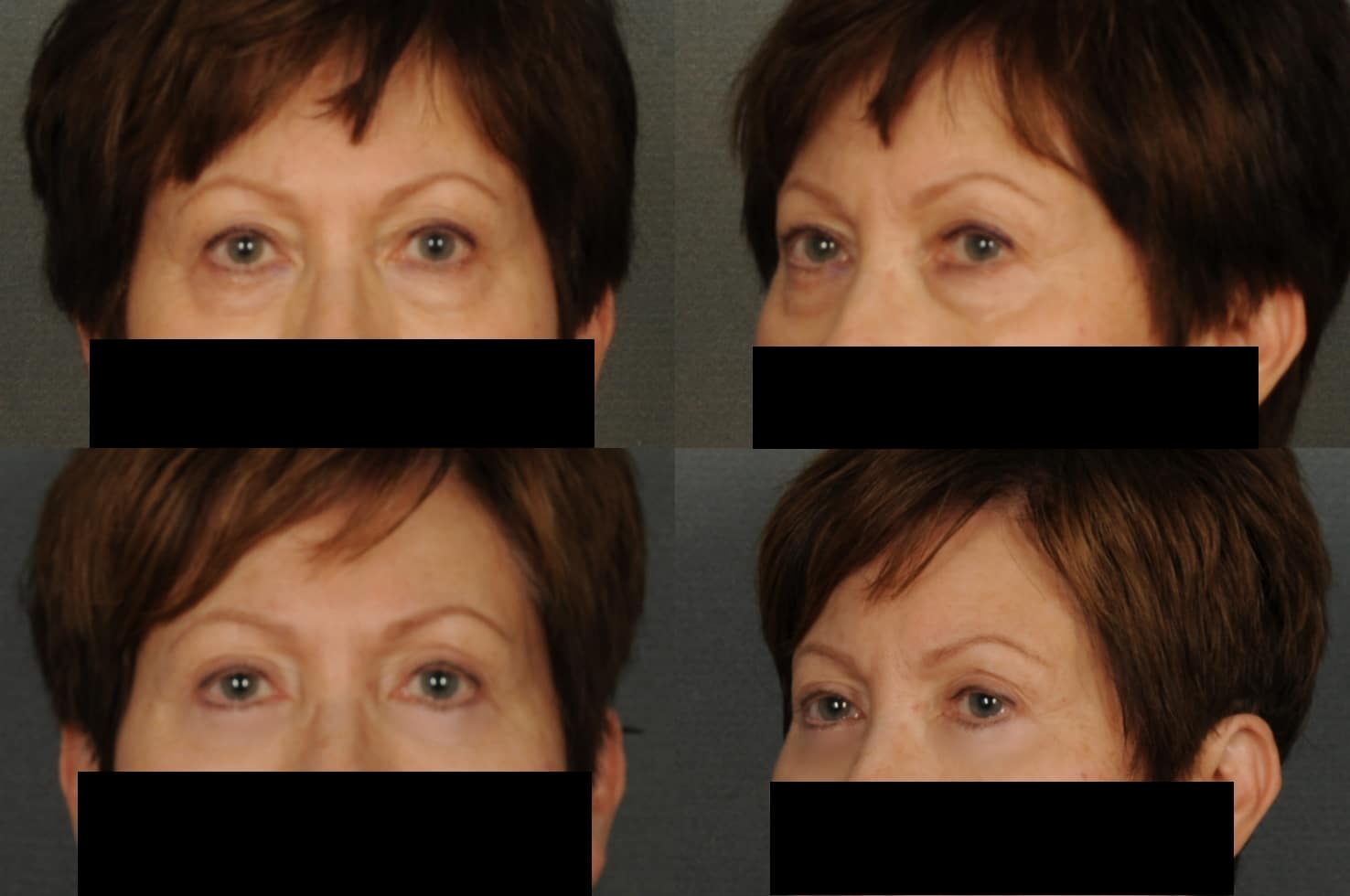 Blepharoplasty Case# 877 Combined Image