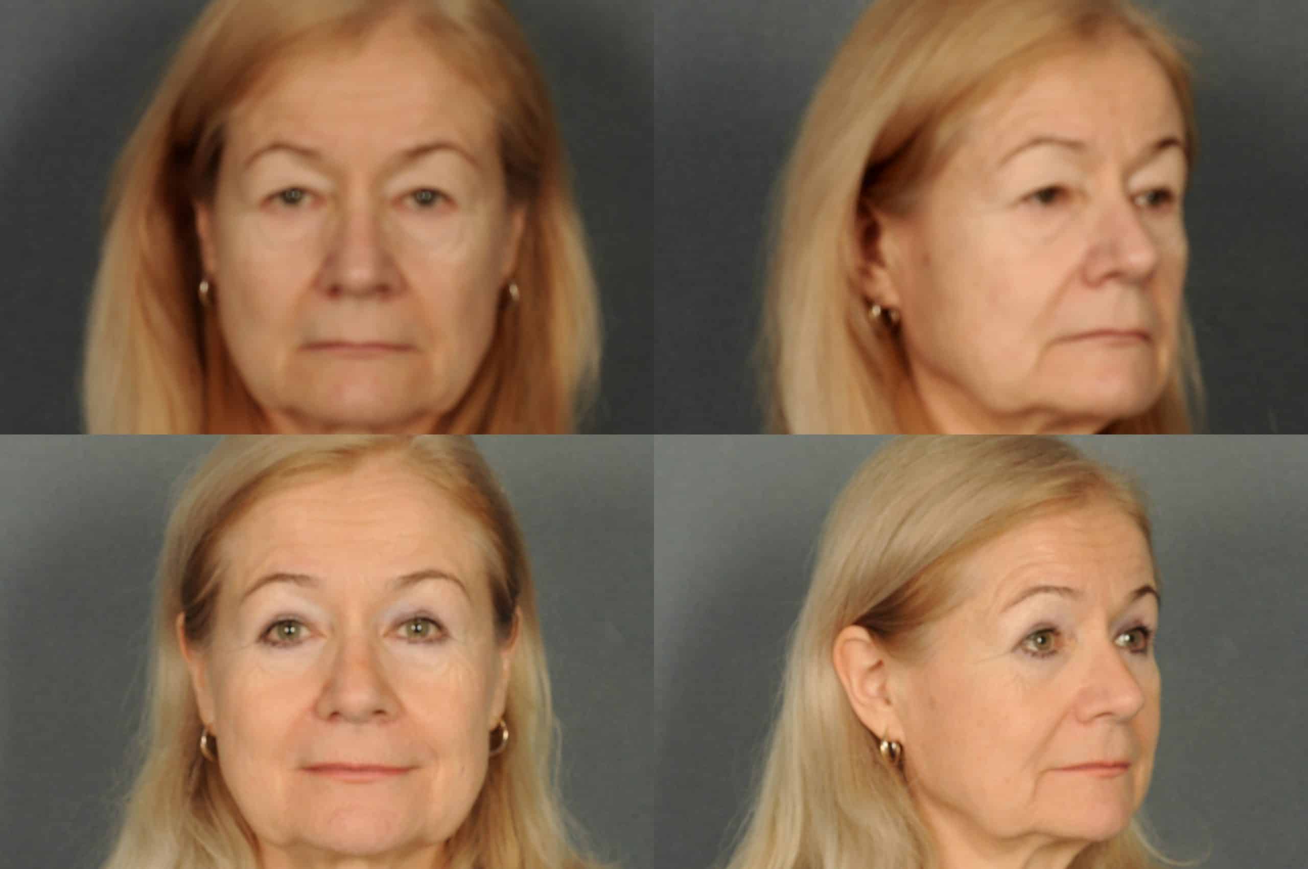 Blepharoplasty Case# 891 Combined Image
