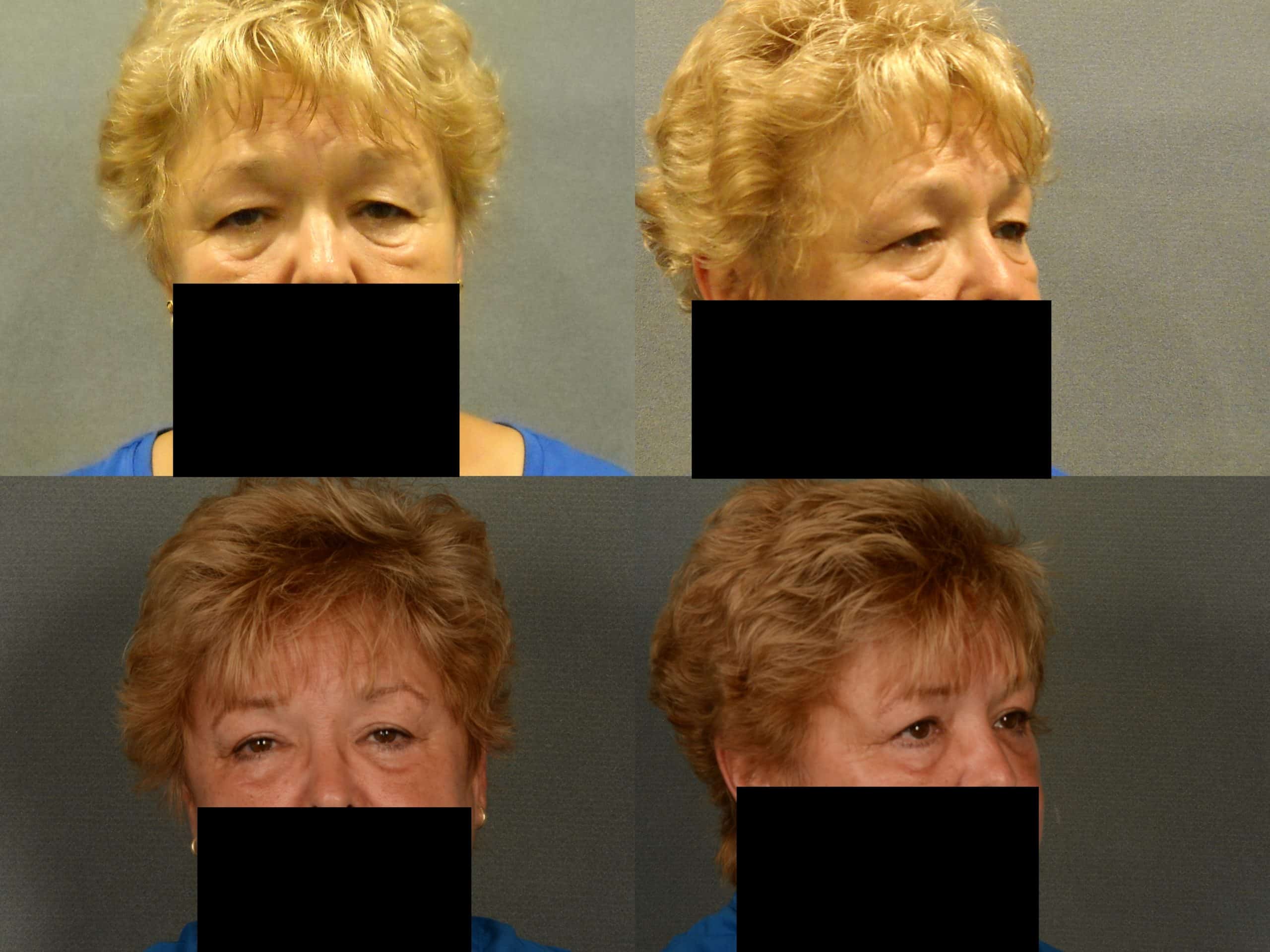 Blepharoplasty Case# 914 Combined Image