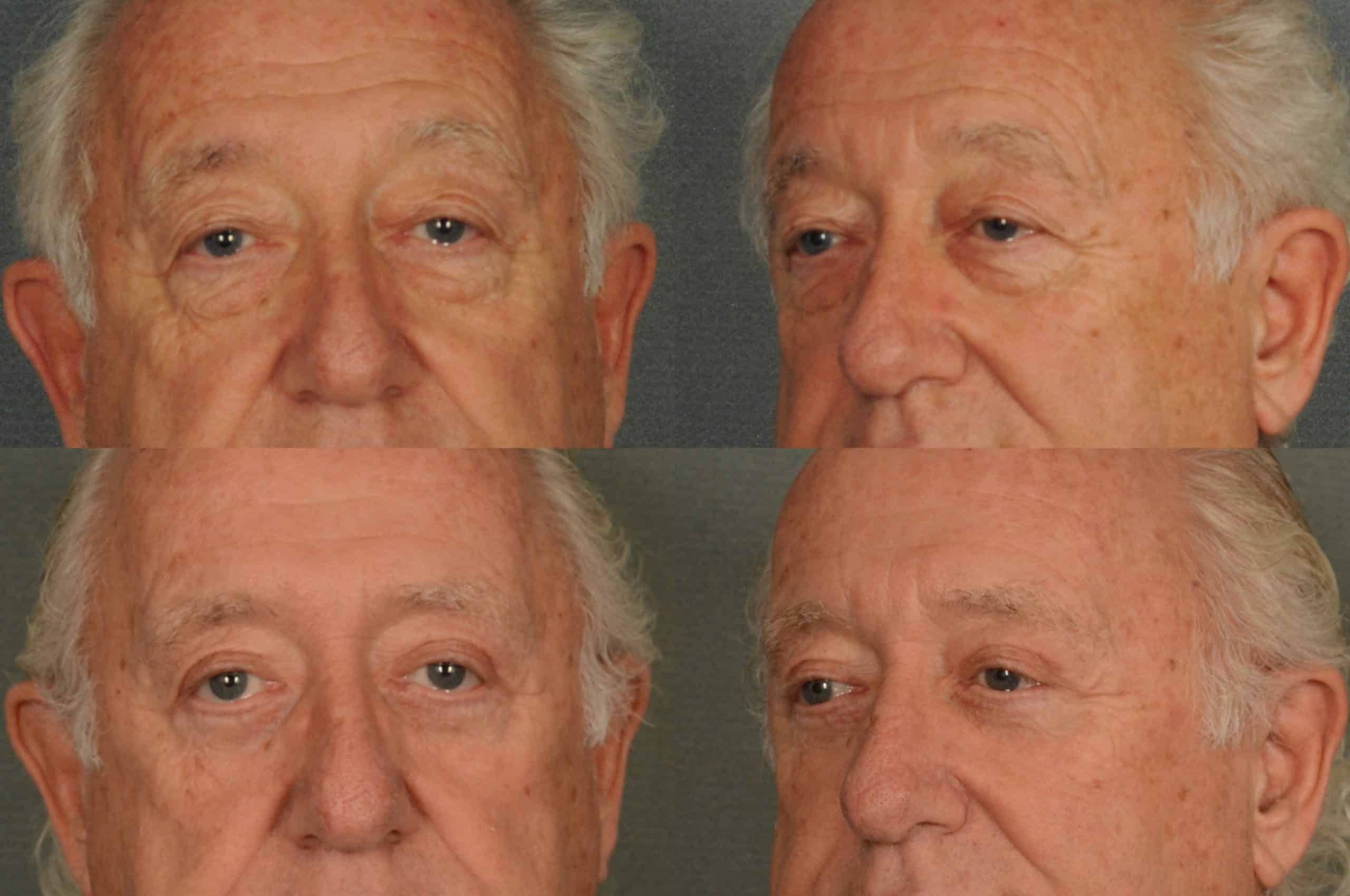 Blepharoplasty Case# 938 Combined Image