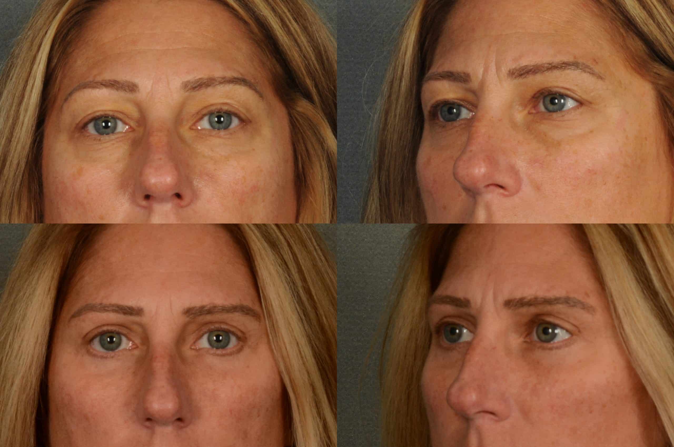 Blepharoplasty Case# 951 Combined Image