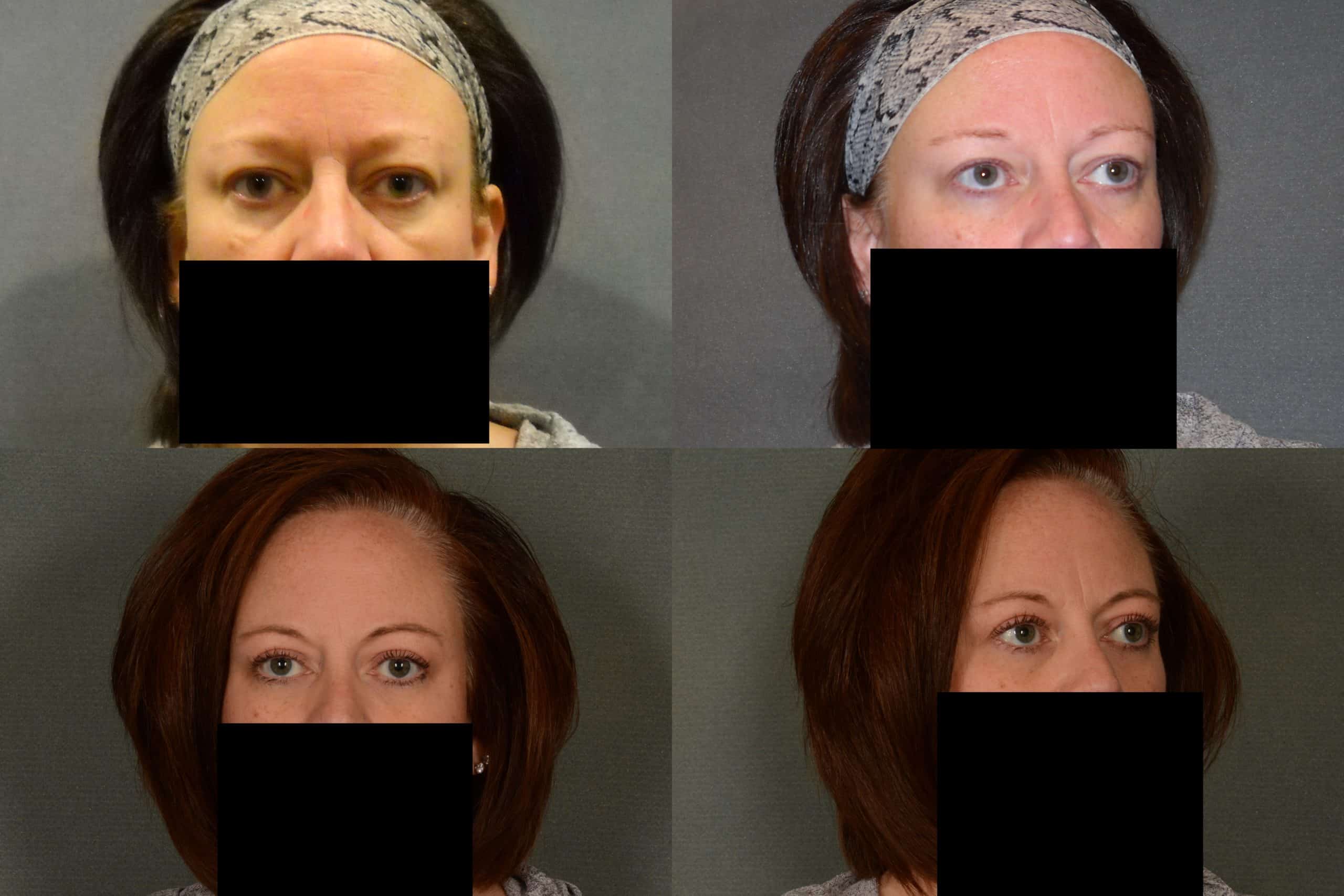 Blepharoplasty Case# 955 Combined Image