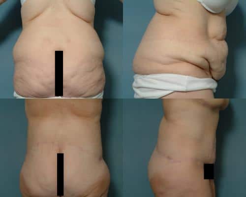 Body Lift Case #166 Combined Image