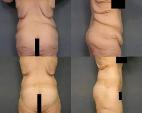 Body Lift Case #167 Combined Image