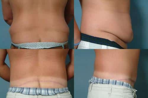 Body Lift Case #168 Combined Image