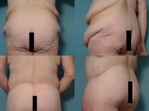 Body Lift Case #169 Combined Image