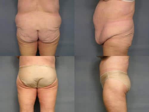 Body Lift Case #170 Combined Image