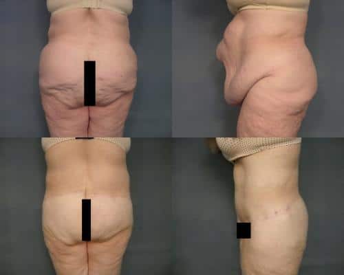 Body Lift Case #171 Combined Image