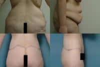 Body Lift Case #213 Combined Image