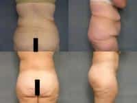 Body Lift Case #214 Combined Image