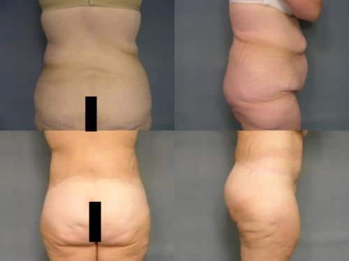 Body Lift Case #214 Combined Image