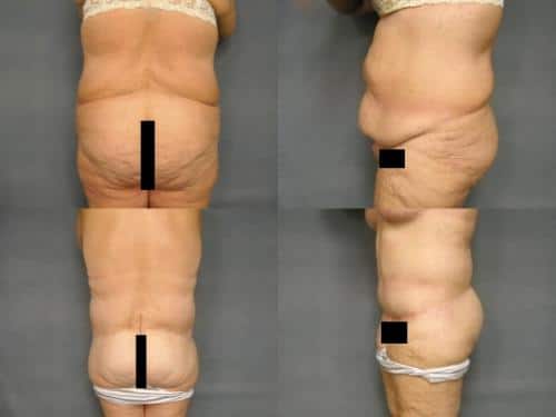 Body Lift Case #243 Combined Image