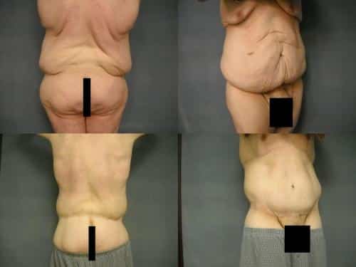 Body Lift Case #255 Combined Image
