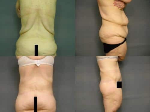 Body Lift Case #284 Combined Image