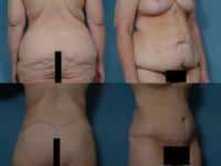 Body Lift Case #286 Combined Image