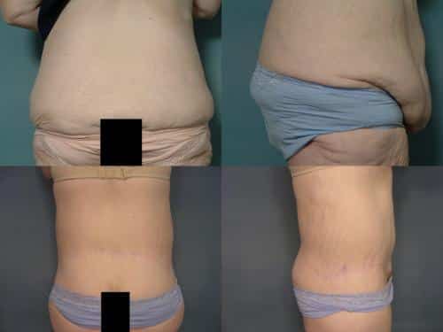 Body Lift Case #287 Combined Image