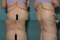 Body Lift Case #801 Combined Image