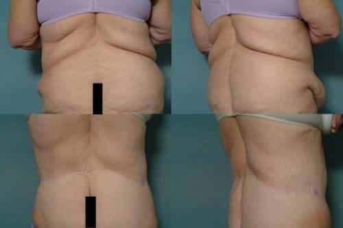Body Lift Case #801 Combined Image