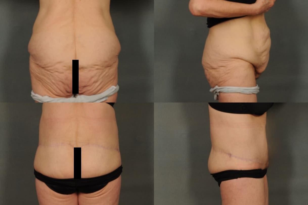 Body Lift Case # 817 Combined Image