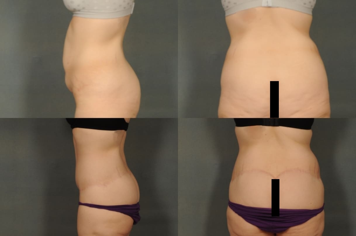 Body Lift Case# 820 Combined Image