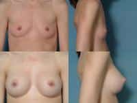 Breast Augmentation Case #114 Combined Image